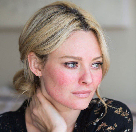 Can Alpha Hydroxy Acids Work with Rosacea Prone Skin?